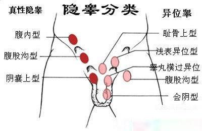 儿童隐睾图片大全,早期识别与治疗关键