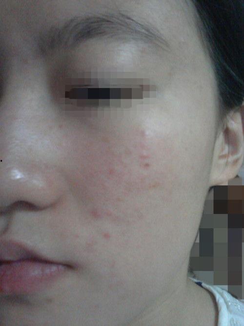 脸上长粉刺图片,揭秘脸上粉刺成因及应对策略