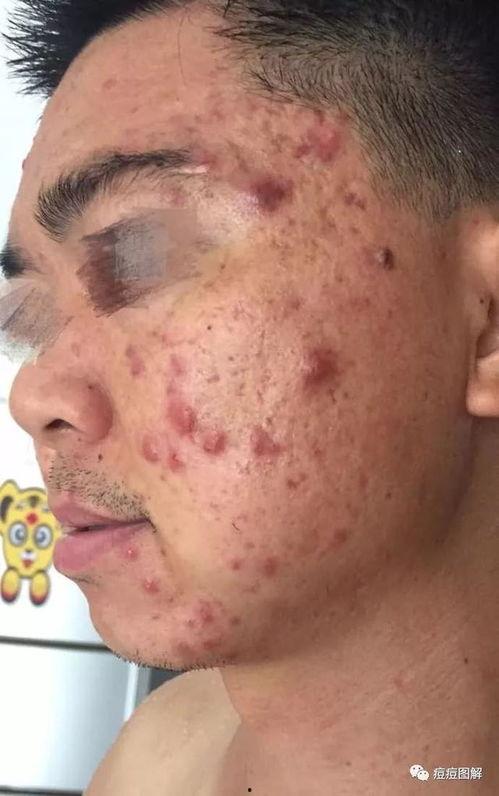 脸上长粉刺图片,揭秘脸上粉刺成因及应对策略