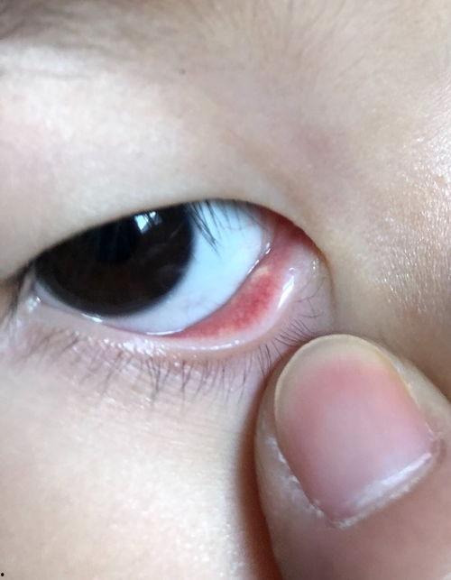 宝宝上眼皮红肿图片,探究原因及应对措施