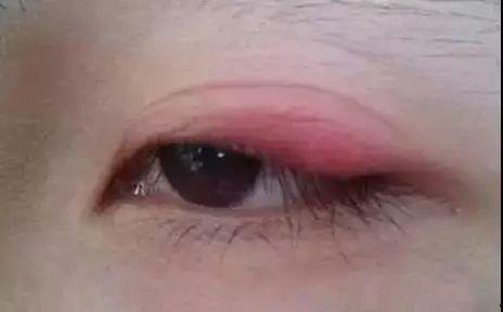 宝宝上眼皮红肿图片,探究原因及应对措施