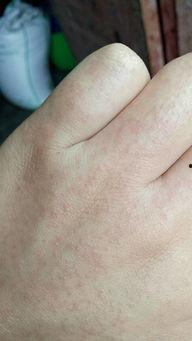 手背上有小红点图片,探寻健康密码