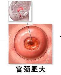 子宫肥大的图片大全集,子宫肥大病例图鉴解析