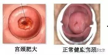 子宫肥大的图片大全集,子宫肥大病例图鉴解析