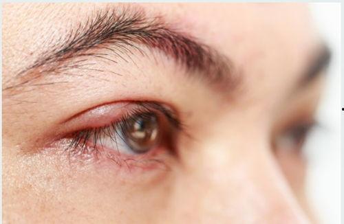 血虚风燥型荨麻疹图片,图片解析与症状概述