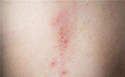 血虚风燥型荨麻疹图片,图片解析与症状概述