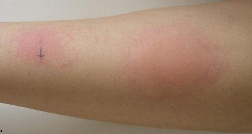 血虚风燥型荨麻疹图片,图片解析与症状概述