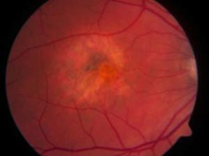 眼睛黄斑病图片,视觉健康危机的影像解析