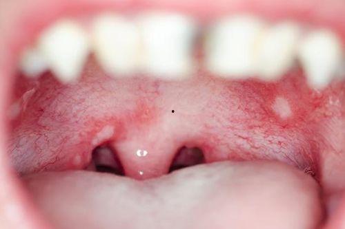 口腔溃疡图片大全,常见症状与自我护理指南