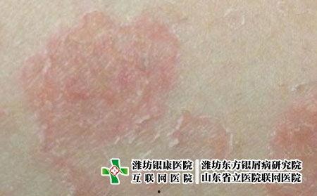 皮肤癣图片,图片揭示常见真菌感染特征